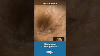 बच्चेदानी Uterus का Dilation और Curettage  Procedure for removing unwanted tissue in uterus [upl. by Rodavlas]