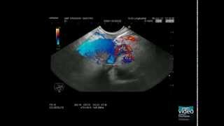 Advanced EUS imaging CEEUS lowMI high MI including 3D techniques in pancreatic imaging [upl. by Schwejda]