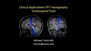 MRI Diffusion Tensor Imaging DTI interpretation  locating the corticospinal tract CST [upl. by Hopper]