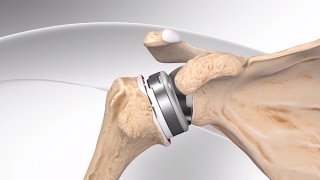 Reverse Total Shoulder Replacement with Univers Revers™ System [upl. by Xuerd]