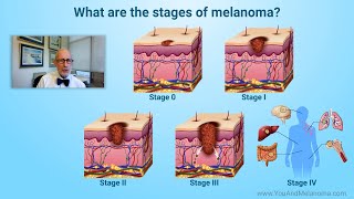 What are the stages of melanoma [upl. by Daiz]