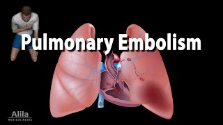 Pulmonary Embolism Animation [upl. by Landsman]