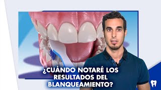 ¿Cuándo notaré los RESULTADOS de un BLANQUEAMIENTO dental  Shorts [upl. by Ydarb543]