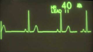 Sinus Bradycardia  ECG Training [upl. by Landa]