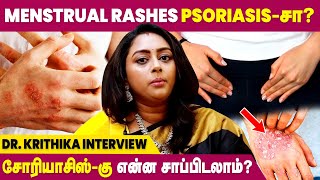 Psoriasis Food Diet  Psoriasis Explained  Dr Krithika [upl. by Oinotla170]