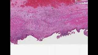 Histopathology GallbladderChronic cholecystitis [upl. by Katzir447]