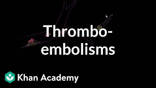 Thromboemboli and thromboembolisms  Miscellaneous  Heatlh amp Medicine  Khan Academy [upl. by Refinnej]