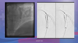 ANGIOPLASTIA COMPLEJA OCLUSION TOTAL DE RAMO DIAGONAL [upl. by Miranda]