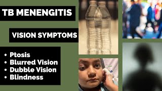 TB Meningitis  Vision symptoms  Double Vision  Blurred Vision  Explained in Hindi [upl. by Deina]