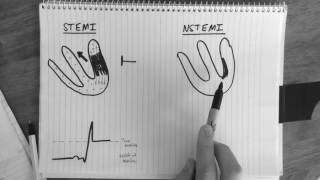 STsegment changes in STEMI amp NSTEMI explained [upl. by Arevle]