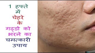 1 हफ्ते में चेहरे के गढ़्डो को हटाने का चमत्कारी उपाय  Acne Scars Home Remedies That Work Fast [upl. by Ydak943]