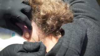 Popping large cyst behind ear [upl. by Signe940]