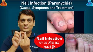 Nail Infection Paronychia  Cause amp Treatment  नाखून संक्रमण का इलाज कैसे करें Dr Puspendra [upl. by Haiacim]