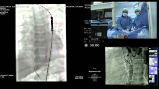 Caso en vivo pediátrico en SOLACI 2014 –Implantación de stent en coartación aórtica [upl. by Herschel414]