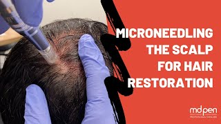 Microneedling The Scalp For Hair Restoration  MDPen [upl. by Baecher]