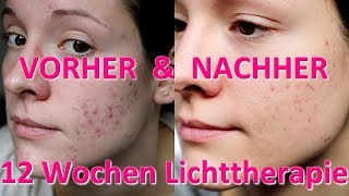 Ergebnis nach 12 Wochen  Neutrogena visibly clear AntiAkne Lichttherapie Maske [upl. by Leff]