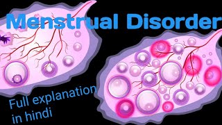 Menstrual Disordernursing lecture Amenorrhoeadysmenorrhoa in hindimenorrhagiatreatmentsymptoms [upl. by Lig452]