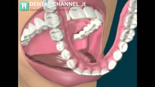 Protesi mobile dentalela dentiera inferiore  DENTAL CHANNEL it [upl. by Bathsheeb]