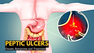 Peptic Ulcers Causes Signs and Symptoms Diagnosis and Treatment [upl. by Ardnalahs]