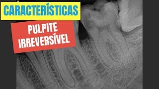 QUAIS SÃO AS CARACTERÍSTICAS DE UMA PULPITE IRREVERSÍVEL  QUICK TIP ENDOLOVERS [upl. by Maxantia750]