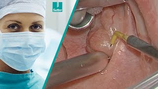 Radiofrequency Tonsillotomy using ARROWtip™  Jochen Windfuhr MD [upl. by Ocirne]