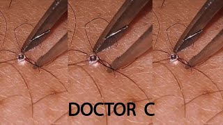 REMOVING INFECTED INGROWN HAIR 08 [upl. by Akinert]