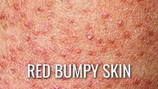 Keratosis Pilaris  How To Get Rid of Chicken Skin [upl. by Eelarual]