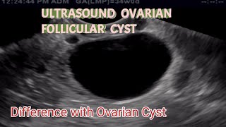 TVS Ultrasound Ovarian Follicular Cyst  Difference with Ovarian Cyst  is This Serious [upl. by Sathrum]