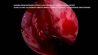 Bleeding from posterior nasal branch of SPA [upl. by Wylma]