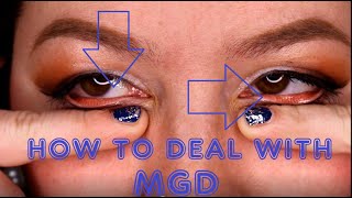 Eyedeology Eye School What is Meibomian Gland Dysfunction MGD [upl. by Haidadej]