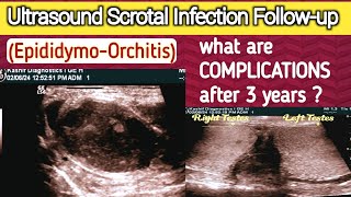 Chronic Scrotal Infection  Complications  Male Infertility  Epididymo Orchitis [upl. by Hubert577]