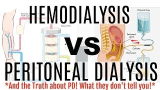 HEMODIALYSIS VS PERITONEAL DIALYSIS Which Dialysis is Best for You [upl. by Topping]