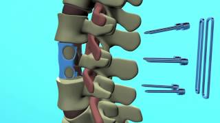 Spinal Animation Vertebral Body Replacement Surgery Ivan Moe [upl. by Editha]