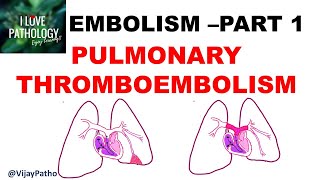 EMBOLISM Part 1 Pulmonary amp Systemic thromboembolism [upl. by Ytsirhc469]