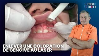 Comment enlever coloration de Gencive au Laser   Frank Pourrat [upl. by Einnil]