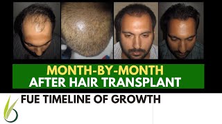 When Will Hair Grow after My Hair Transplant  Darling Buds [upl. by Miyasawa]