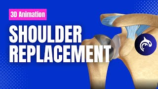 Shoulder Replacements Total vs Reverse vs Partial [upl. by Orelie268]