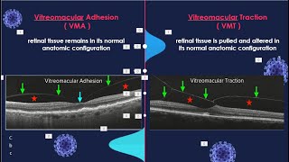 VMA vs VMT  One Minute OCT [upl. by Lachish276]