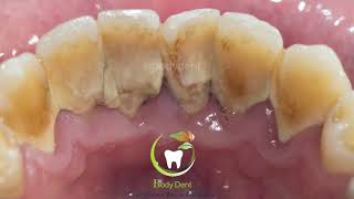 limpieza dental tipos  PROFILAXIS y DETARTRAJE [upl. by Aneryc374]