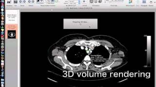 OsiriXsimulated Navigation S1lung segmentectomy [upl. by Nivat]