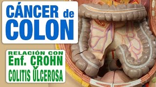 Cáncer de Colon y Enfermedad Inflamatoria Intestinal [upl. by Jaela]