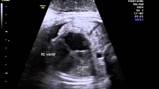 Dilated cardiomyopathy with associated MR and TR in fetus [upl. by Adnilemreh]