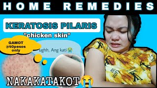 Paano gamutin ang KERATOSIS PILARIS also known as CHICKEN SKINHOME REMEDIES 40PhpTagalogRONA J [upl. by Fisoi919]