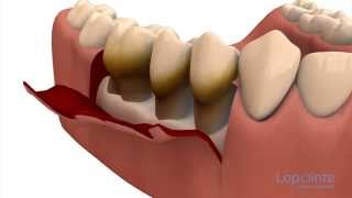 Parodontie par lambeaux  Centres dentaires Lapointe [upl. by Nagam]