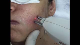 Besenreiser Couperose und Rosacea entfernen mit NdYagLaser [upl. by Yelkao881]