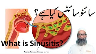 Sinusitis Part 1  Causes Risk Factors Pathophysiology Types Symptoms and Complications  Urdu [upl. by Daisi]