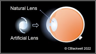 Intraocular Lenses 2 Vision After Surgery [upl. by Rezeile424]