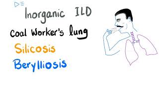 Silicosis Berylliosis amp Coal Workers Pneumoconiosis  Interstitial Pulmonary Fibrosis [upl. by Llehsar]