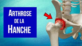 Arthrose de la hanche  Explication et Traitement [upl. by Cuhp]