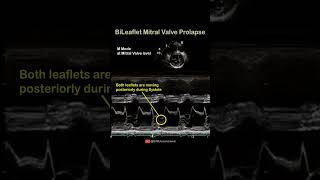 BiLeaflet Mitral Valve Prolapse echocardiography cardiology [upl. by Eidahs]